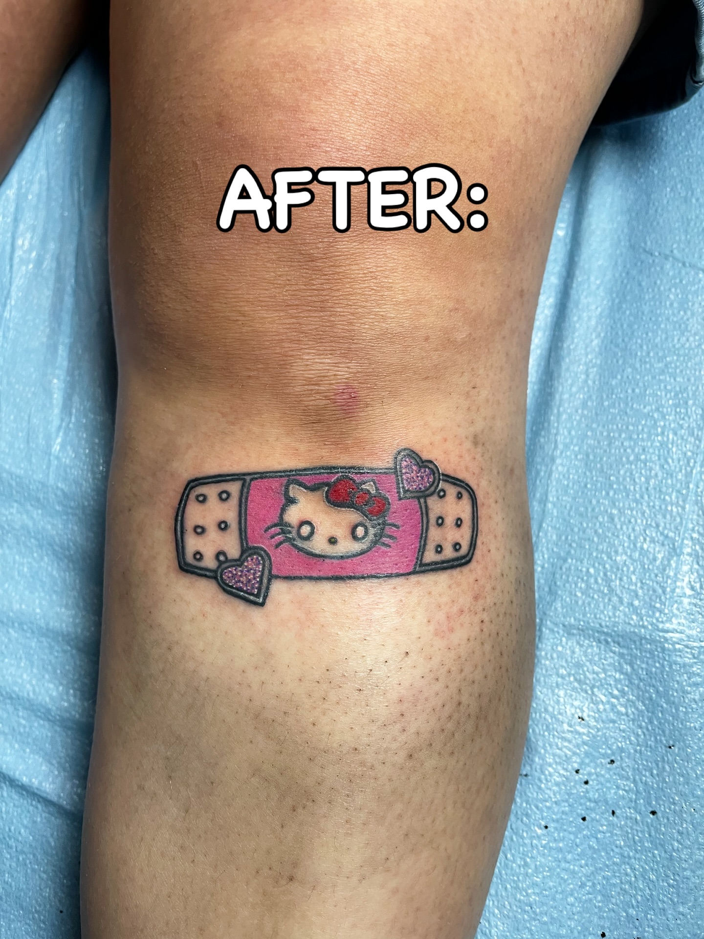 Band aid with Hello Kitty dotwork tattoo on the forearm by The Reelist Ink